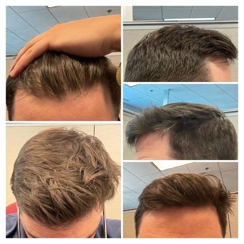 7+ years on only finasteride - before and after. Details in comments ...