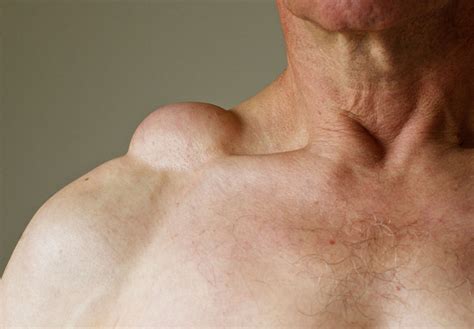 Lipoma - treatment, symptoms and diagnosis | healthdirect