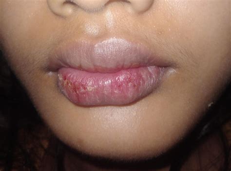 bibir kering hellosehat