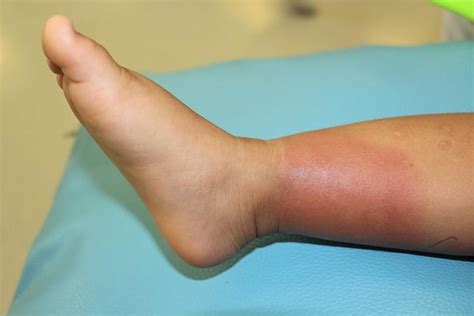 Staph Infections In Kids: Symptoms, Treatment & Home Remedies