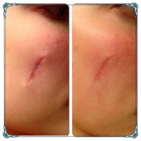 Sebaceous Cyst Removal Scar