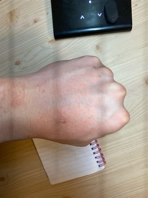 What are these spots on my thighs that I keep flaring up with? They