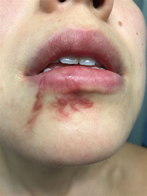 How Do Dog Bites Heal