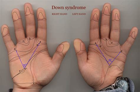 Down Syndrome Short at Erik Walker blog