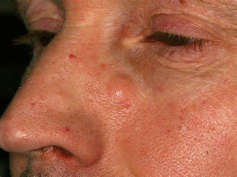 How to Spot and Treat Epidermoid Cysts