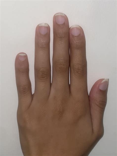 my fingers look deformed. my finger tips are short and stubby n my nail ...
