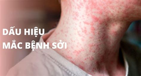 Những điều cần biết về BỆNH SỞI
