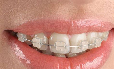 Clear Teeth Braces 101: Uses And Benefits - Reproductive Healths ...