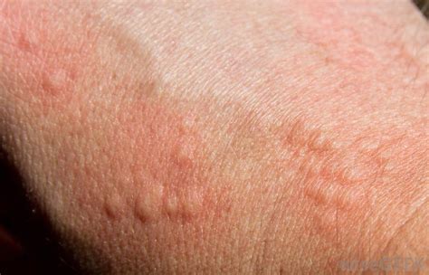 biotin rash - pictures, photos
