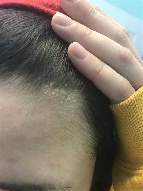 Grows like scales :( : r/dandruff