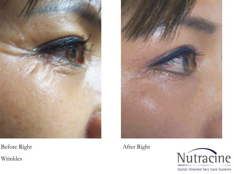 Wrinkles Around Eyes Before And After at Abbey Battye blog