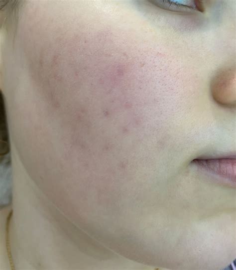 Galderma Сетафил DERMA Control SPF 30. Аптечная защита от солнца с ...