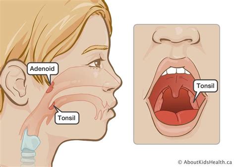 Tonsil surgery or tonsil and adenoid surgery: Caring for your child ...