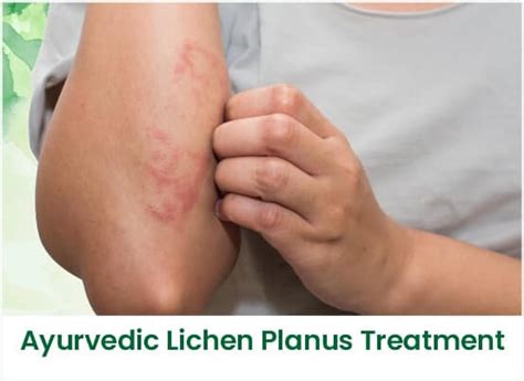 ayurvedic lichen planus care pune skin hair ayurved