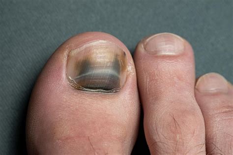 premium photo damaged toenail hematoma   thumb