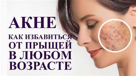 АКНЕ, как избавиться от прыщей в любом возрасте. Простое средство от ...