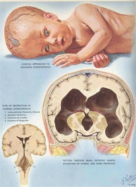 Meningocele E Hidrocefalia - Personas con Hidrocefalia y Mielomeningocele