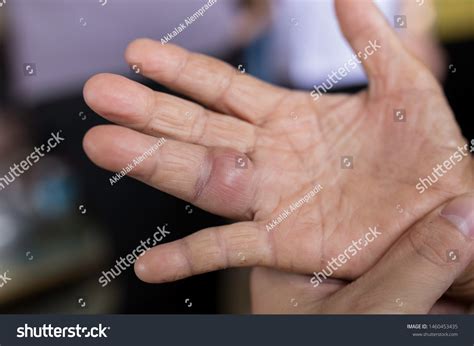 Infection Symptom On Hand Old Patient Stock Photo 1460453435 | Shutterstock