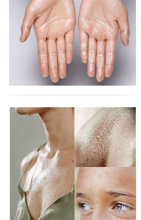 Hyperhidrosis - Palm Beach Dermatology Group