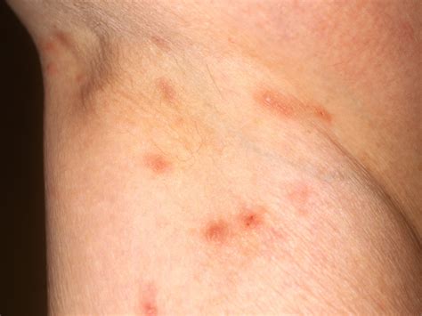 Scabies Rash