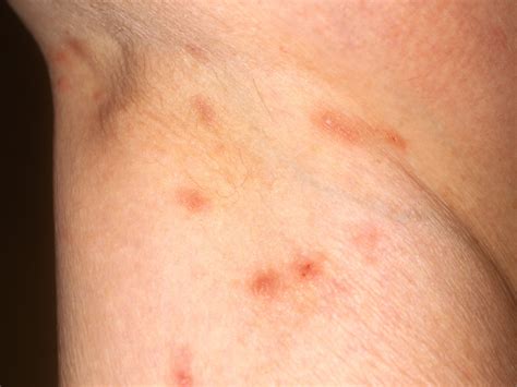 Rashes That Look Like Scabies: Causes, Symptoms, And Treatment ...