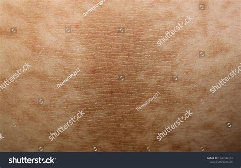 Case Acanthosis Nigricans Male Diabetes Stock Photo 1646342104 ...
