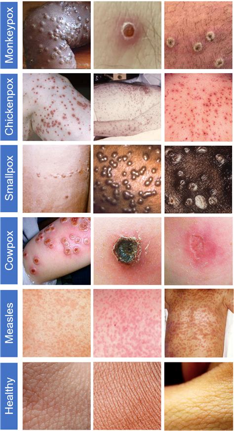 Chicken Pox Symptoms Chart