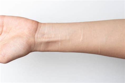 Wrist Slash Cutting Razor Blade Stock Photos, Pictures & Royalty-Free ...