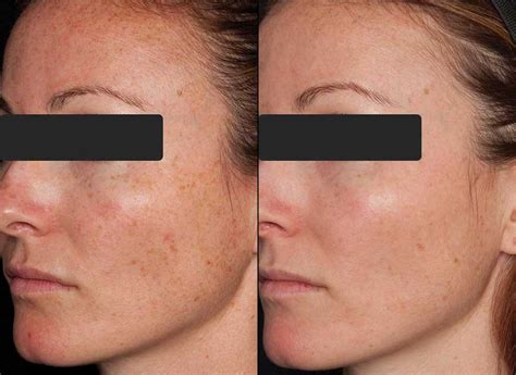 Sesderma - The Power of the Peel