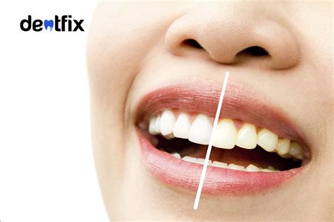 yellow teeth teeth discoloration explained dentfix