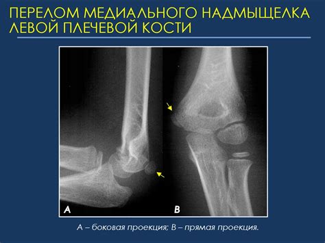 Медиальный надмыщелок плечевой кости: лечение травмы у детей и взрослых