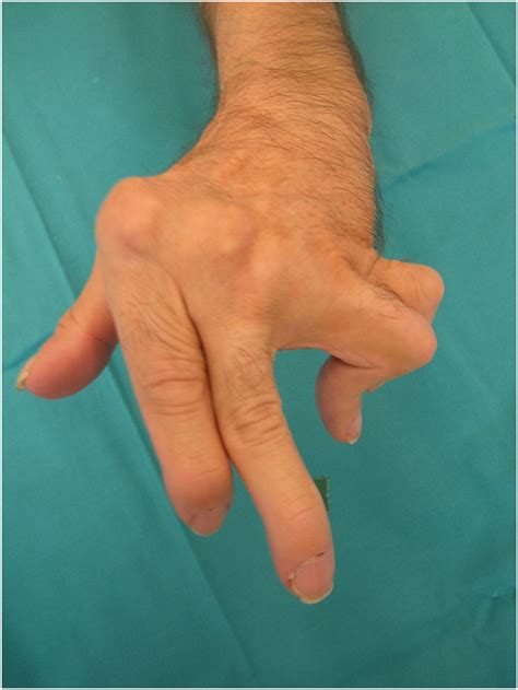 swan neck  boutonniere deformity  rheumatoid hand hand clinics