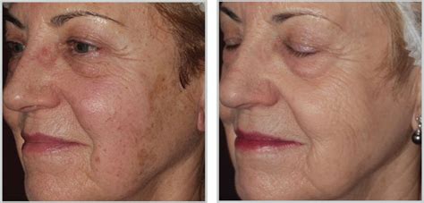Forever Young BBL |Tyte Medispa Millbrook,NY