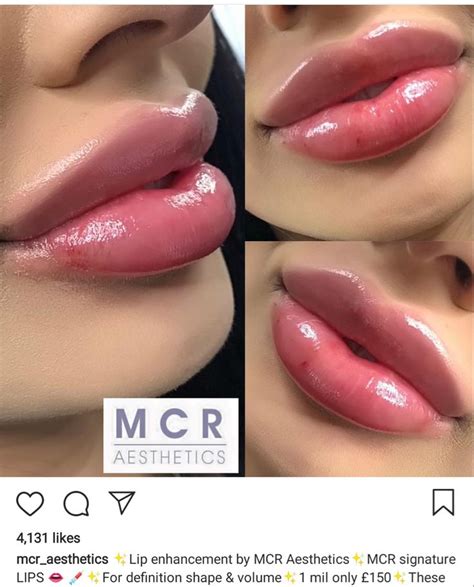 Lip Filler Gone Wrong | Botox lips, Fake lips, Lip fillers