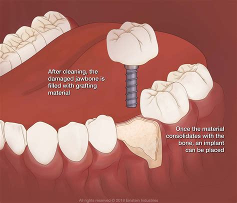 bone grafting los algodones mexico mexicali cosmetic implant
