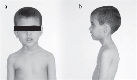 a-b. Photographs of the patient: Note the macrocephaly and the ...