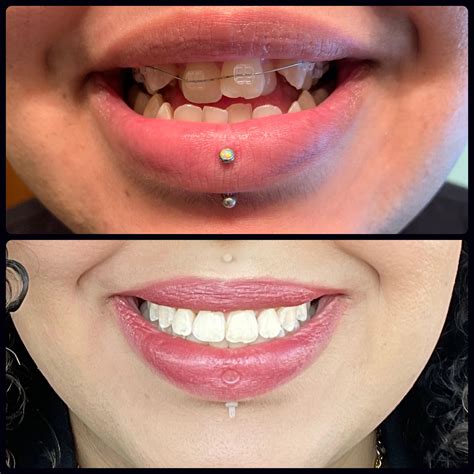 How do braces work for pulling the teeth outwards? I'm very curious and