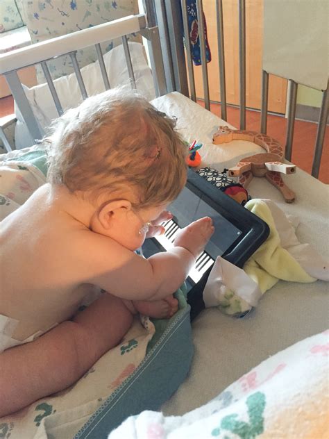 Apert Syndrome | eagar4life