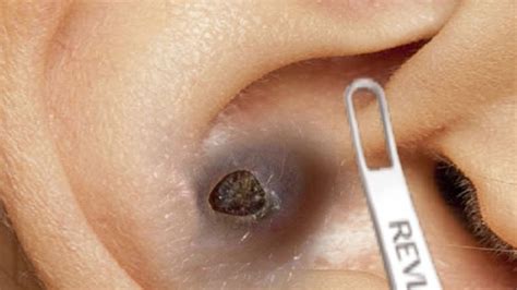 Unbelievable Blackhead Removal 2024: The Year's Biggest Breakthrough - 2e9w9hf