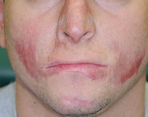 Keloid | School of Medicine
