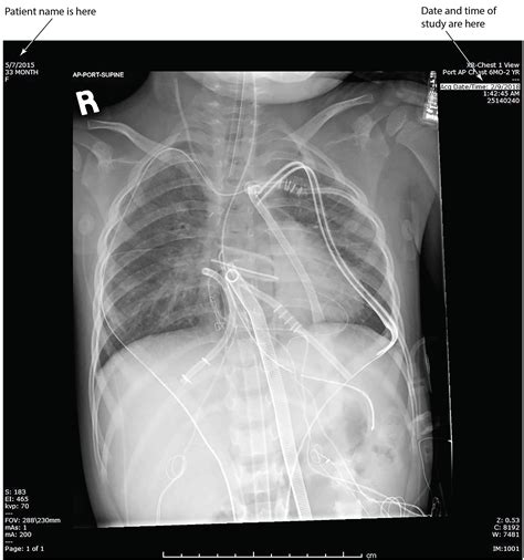 Proper Position Of Endotracheal Tube at Layla Helms blog