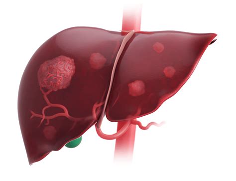 Hepatocellular Carcinoma (HCC) Treatment Approach