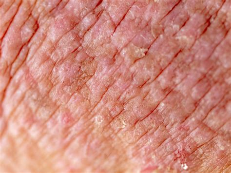 Eczema Skin Rashes That Look Like