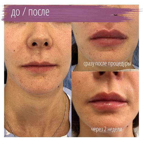 Обрезанные половые губы фото до и после