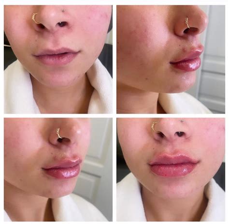 Types of Lip Fillers and How to Pick the Perfect One for You