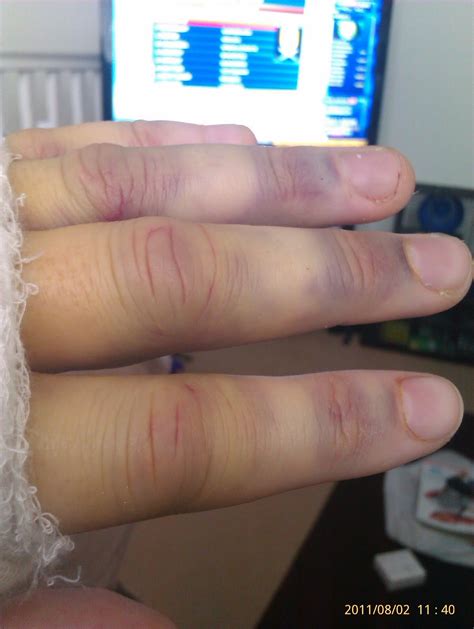 Katies bits and blogs: Wrist fusion surgery :S