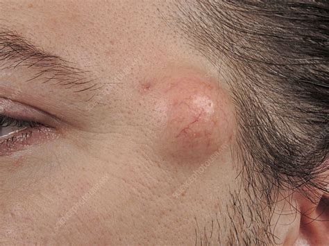 Epidermoid Cysts Face Cysts Types And Treatment | Venice, FL