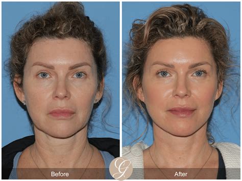 Lower Facelift & Deep Plane Necklift Case 2 Before After Photos Orange ...