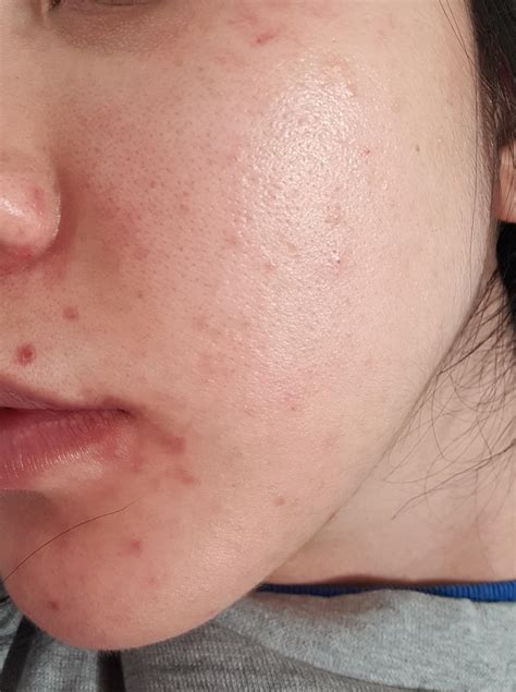 Azelaic Acid With Tretinoin 5