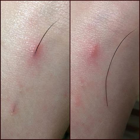 Groomer's hair splinter : popping